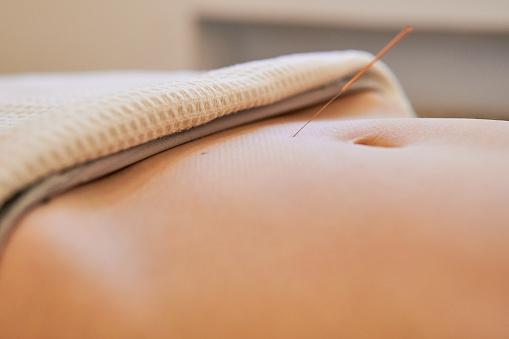 Akupunktura dla płodności