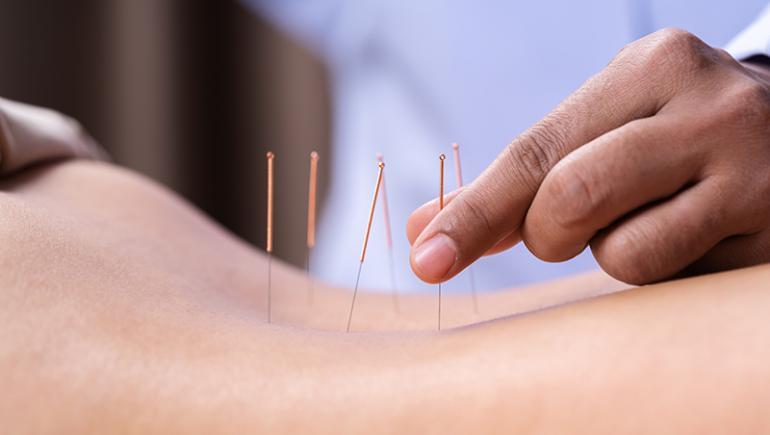 Jak zwiększyć szansę na ciążę - akupunktura
